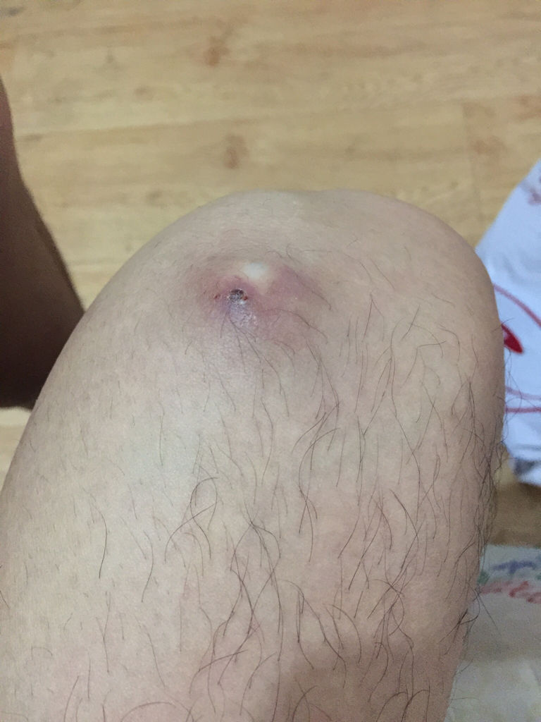 痘痘長(zhǎng)不出來(lái)，肉里硬硬的，原因解析與應(yīng)對(duì)建議，痘痘無(wú)法冒出表面，內(nèi)部硬結(jié)成因解析及應(yīng)對(duì)之策