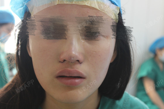 不動手術縮小鼻頭，自然方法與實用技巧，自然縮小鼻頭的方法與實用技巧分享