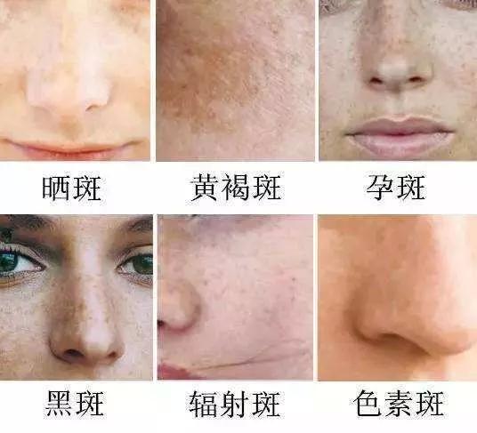 如何有效去除臉上斑點——全方位指南，全方位指南，如何有效去除臉上斑點