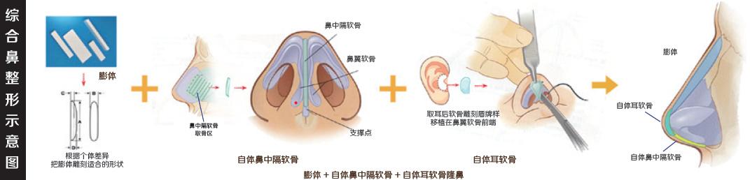 整鼻子手術(shù)費(fèi)用一般是多少，鼻子整形手術(shù)費(fèi)用詳解