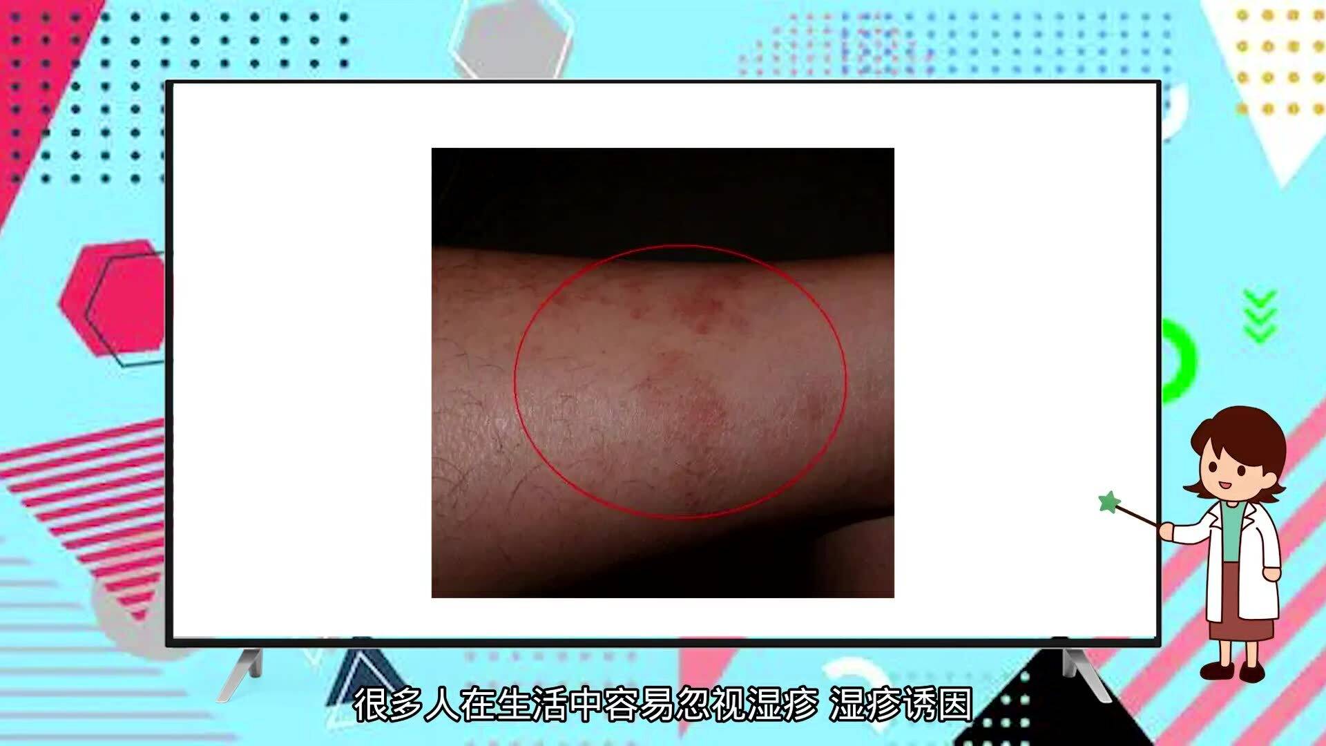 蕁麻疹夜晚止癢妙招，讓你遠(yuǎn)離瘙癢困擾，蕁麻疹夜晚止癢小妙招，告別瘙癢煩惱